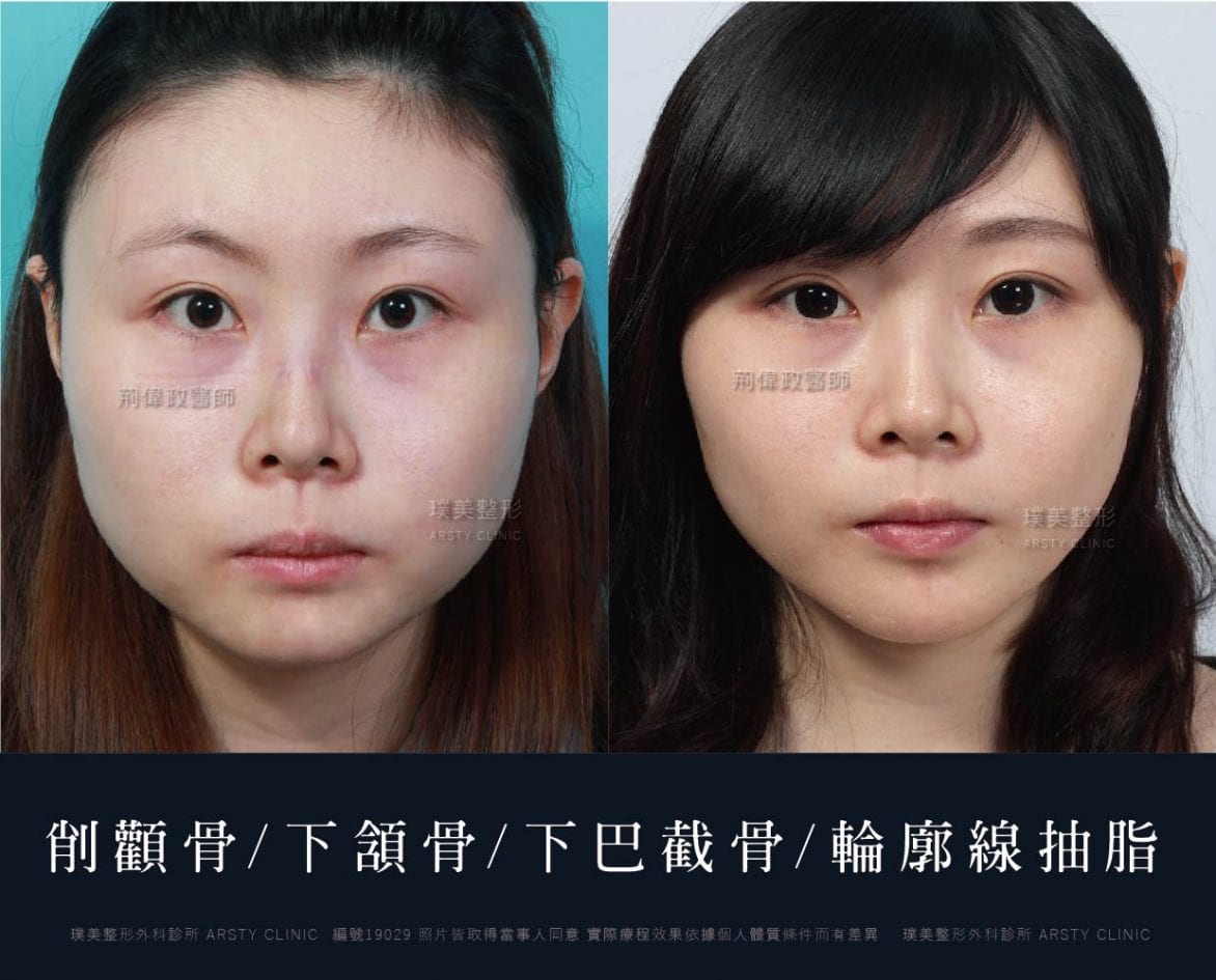 下巴整形必先搞懂關鍵 墊下巴 下巴截骨差別 璞美整形外科