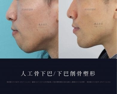 人工骨下巴.下巴手術.台北推薦下巴dcard推薦.墊下巴手術 人工骨下巴.下巴手術.台北推薦下巴dcard推薦.墊下巴手術