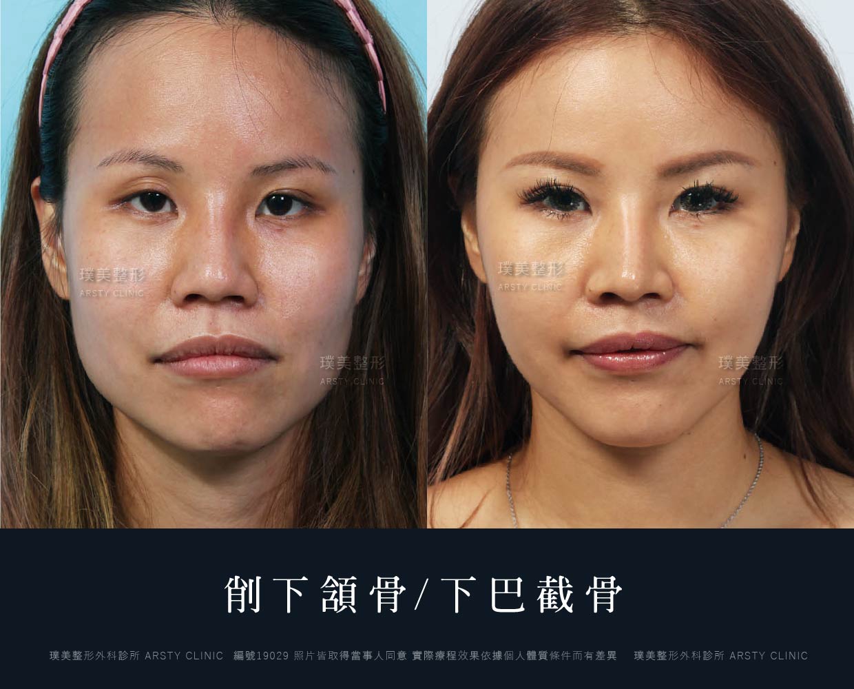 削骨手術前後比對案例-全臉骨隱痕微創客製化精雕 28 下巴截骨手術下巴手術荊偉政醫師下巴權威下巴推薦下巴手術費用下巴手術推薦下巴ptt推薦下巴價錢下巴失敗下巴風險下巴疤痕下巴台北推薦下巴dcard推薦