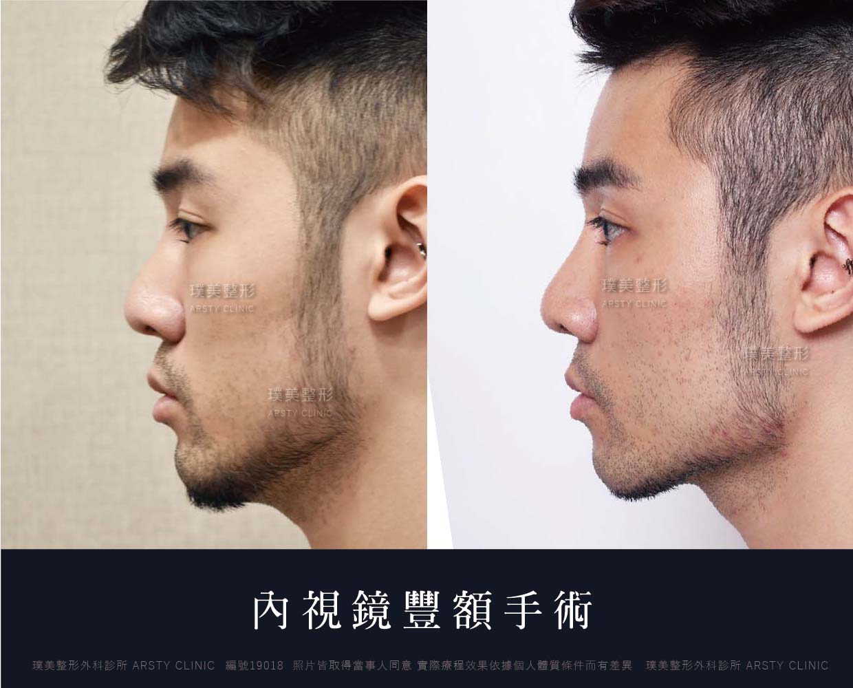 G_Forehead Case Comparison-01