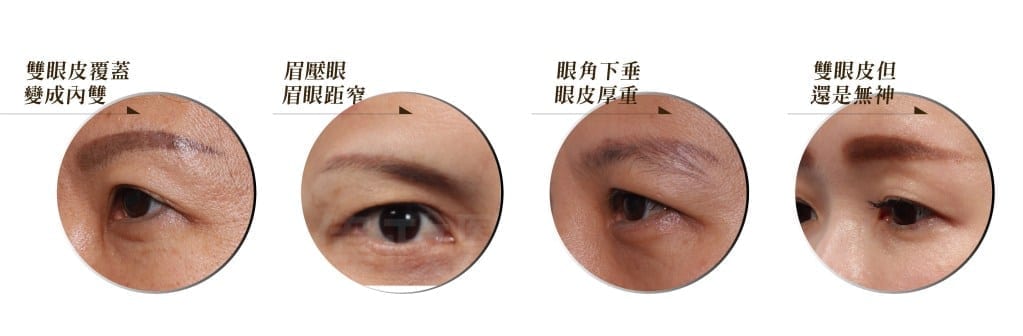 內視鏡微創提眉推薦荊偉政醫師提眉手術可改善的眼周鬆弛
