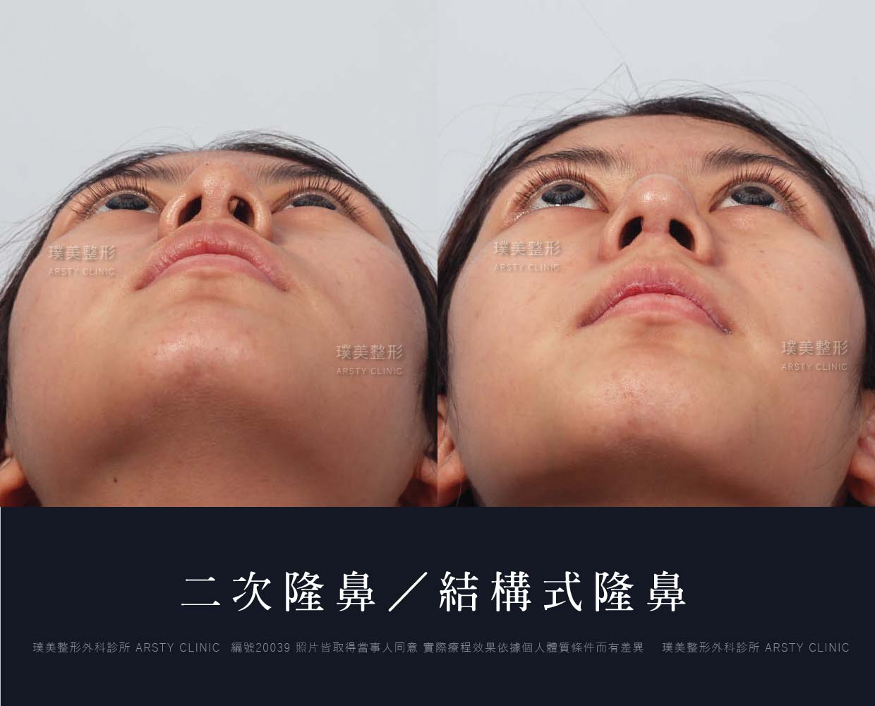鼻案例對照圖-29-1