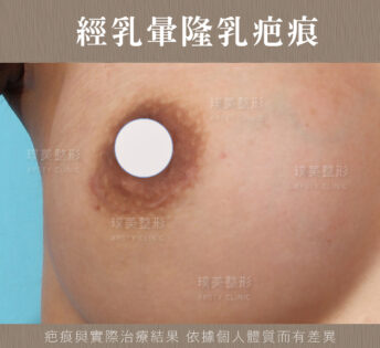 自體脂肪隆乳-天然系渾圓美胸再造 55 乳暈切口疤痕範例
