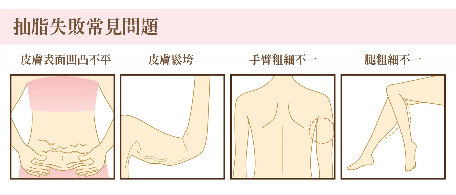 抽脂失敗 二次抽脂手術修復術後凹凸不平 璞美整形外科