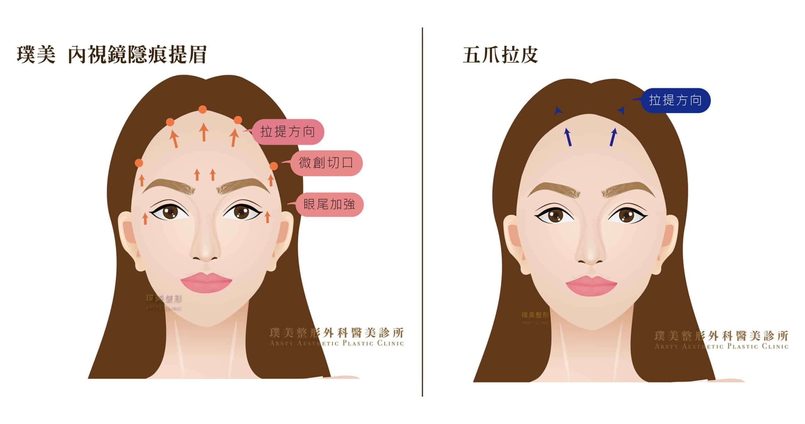 Comparison of Endoscopic Forehead Lift and five-point facelift directions - scaled-3