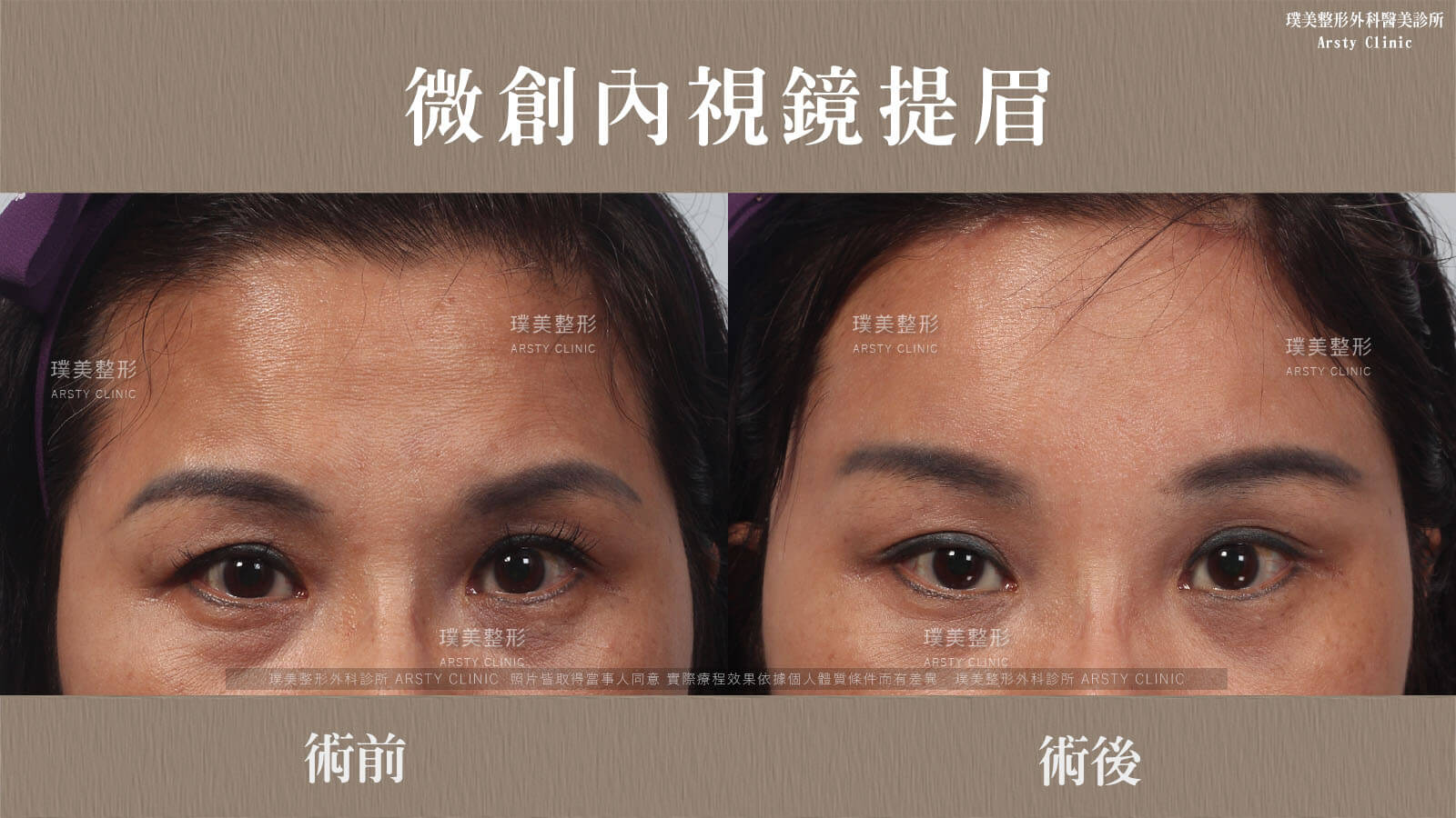 內視鏡提眉+縫雙眼皮案例ab圖