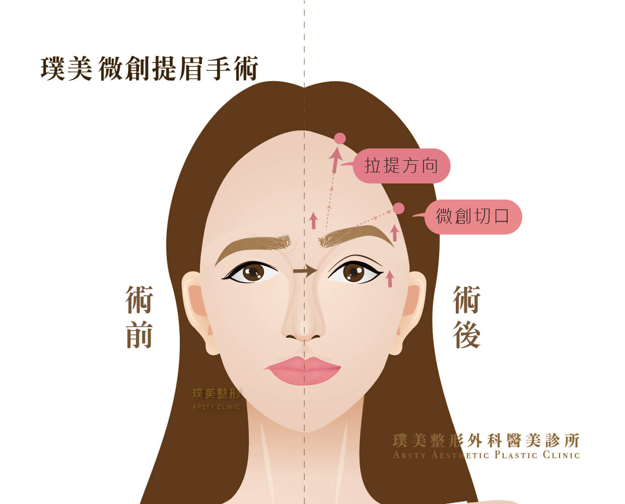 Subbrow incision incision 201907_Eye improvement - 1