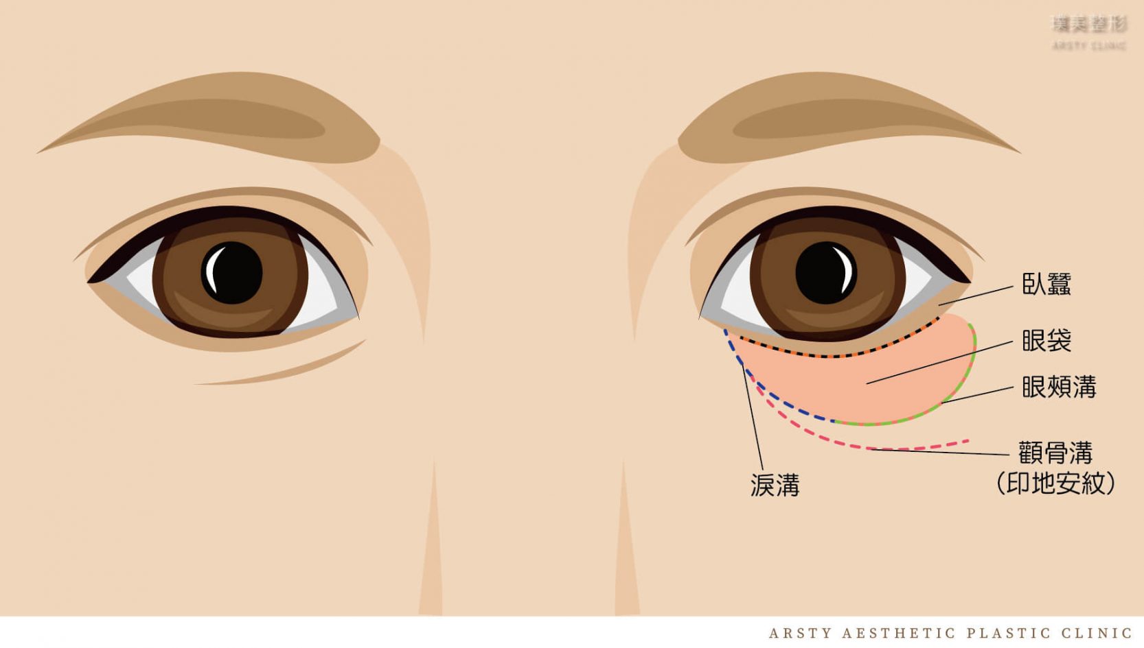 眼袋手術部位示意圖