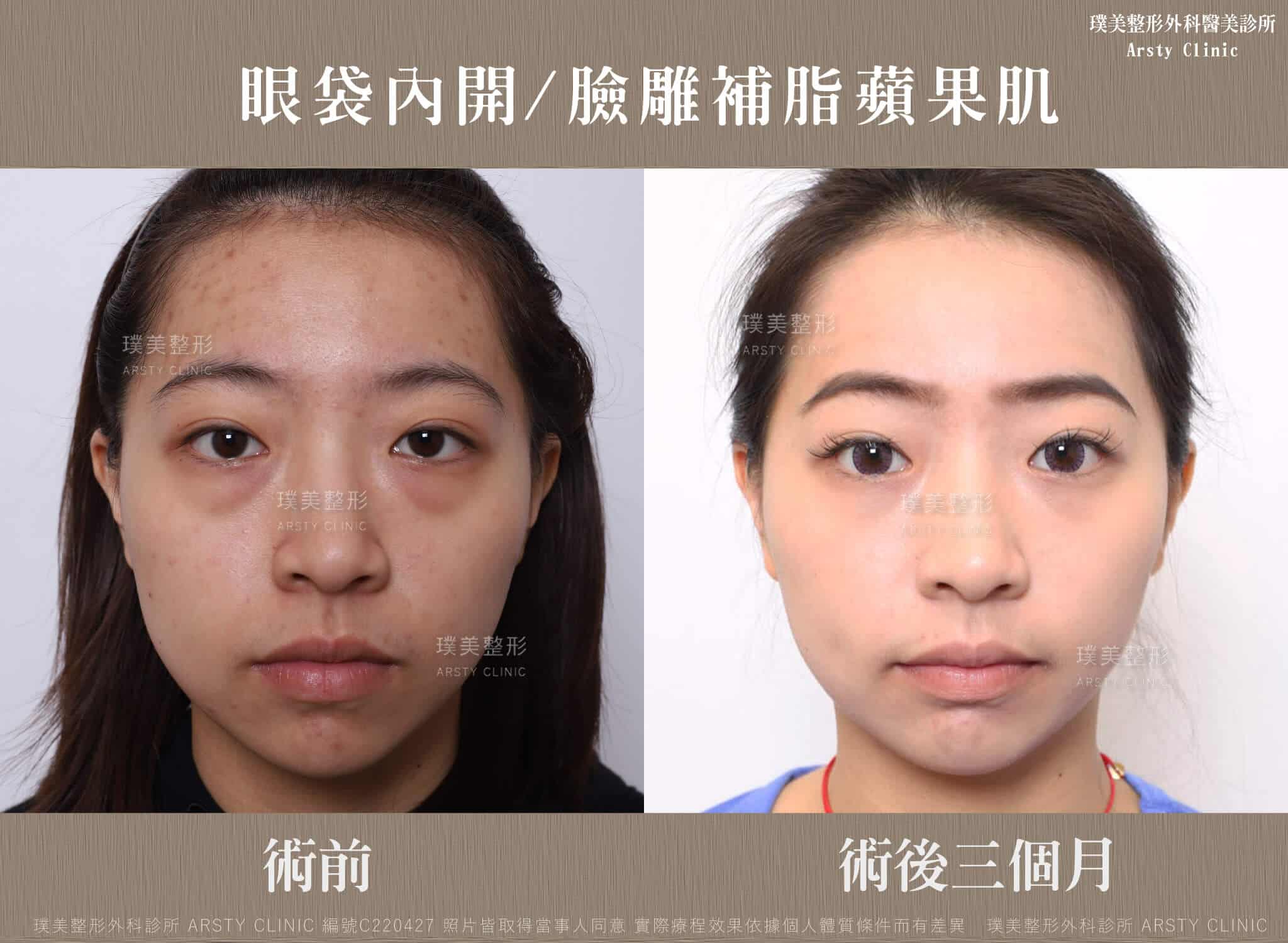 眼袋內開_臉雕補脂蘋果肌_D220427-3MBA01