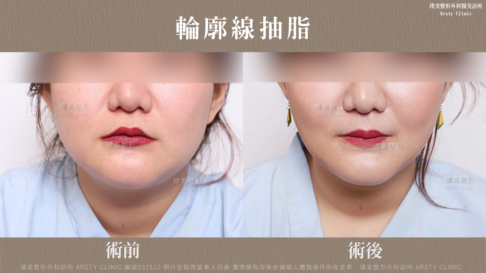 Facial contour liposuction_Arsty Clinic Liposuction_Bureau 032512_01-1