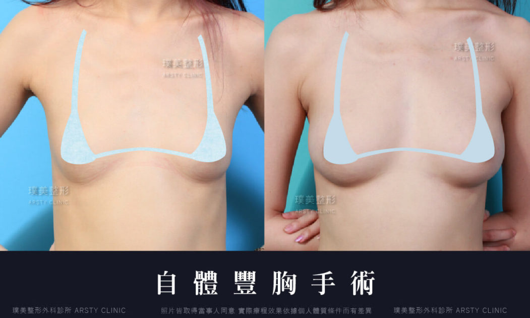 自體脂肪豐胸隆乳手術_比基尼遮罩_117自體脂肪隆乳_抽脂Fat Graft for Breat Augmentation Case