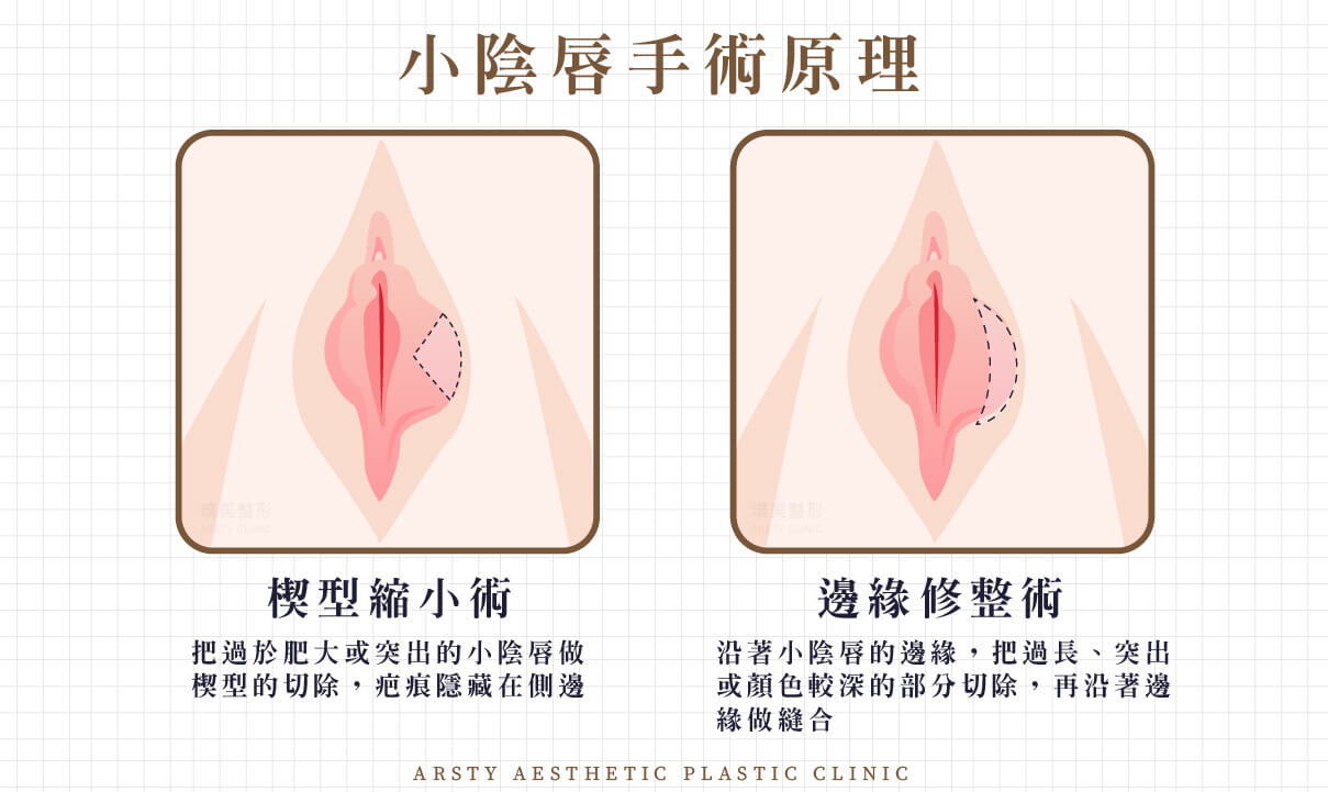 小陰唇手術原理邊緣修整、楔型縮小