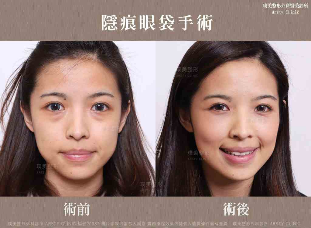 隱痕眼袋手術-BA-B221005-生活