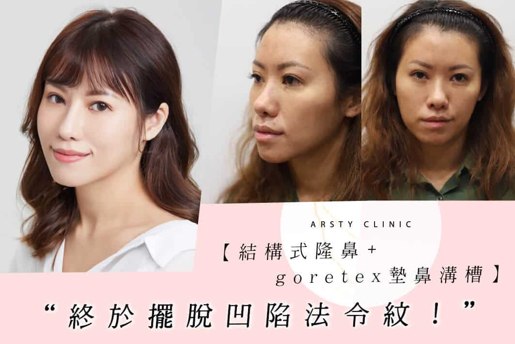 0312021 Structural Augmentation Rhinoplasty with Nasal Groove Filler - 6-1