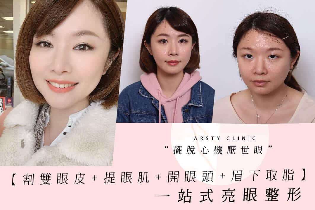083131-割雙眼皮-開眼頭-提眼瞼肌-眉下取脂-13-1