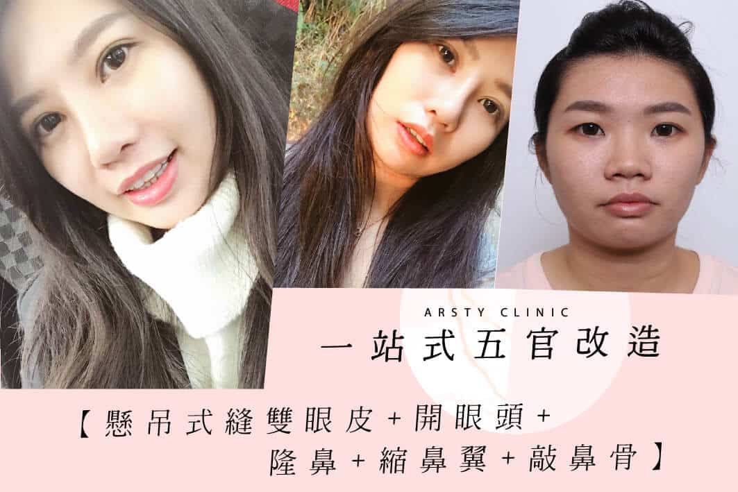 縫雙眼皮-開眼頭-隆鼻-縮鼻翼-敲鼻骨-10-1