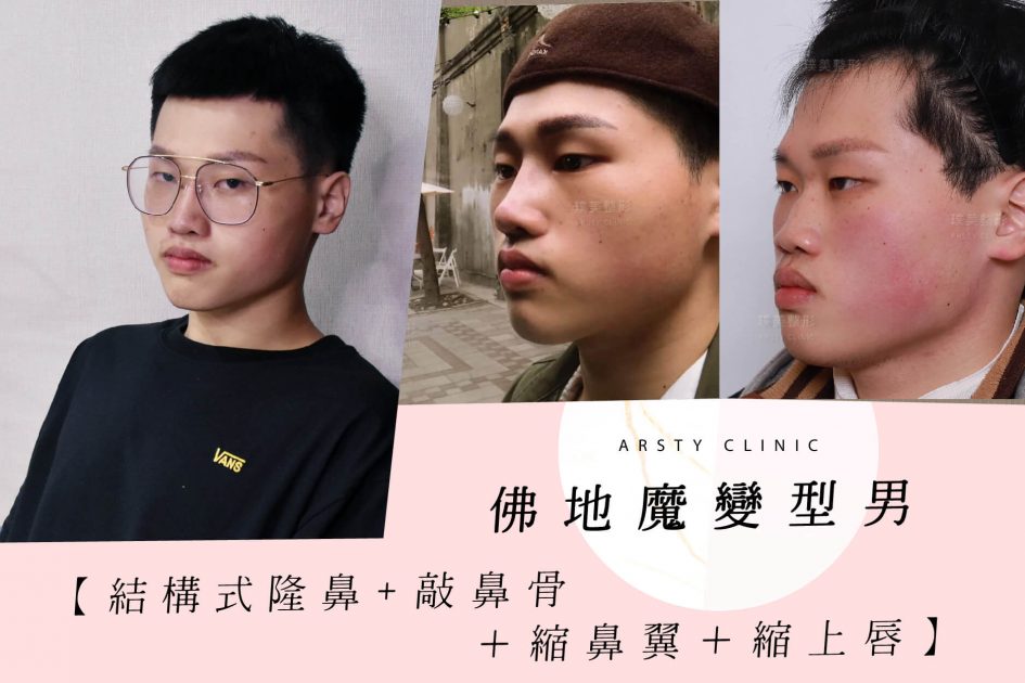 隆鼻 敲鼻骨 縮鼻翼 縮上唇 隆鼻手術後 沒人叫我佛地魔了 璞美整形外科