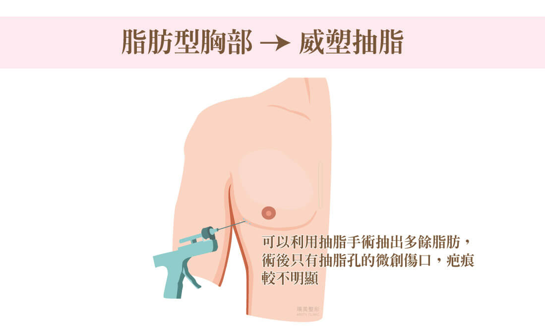 女乳症縮胸手術原理、脂肪型胸部、威塑抽脂