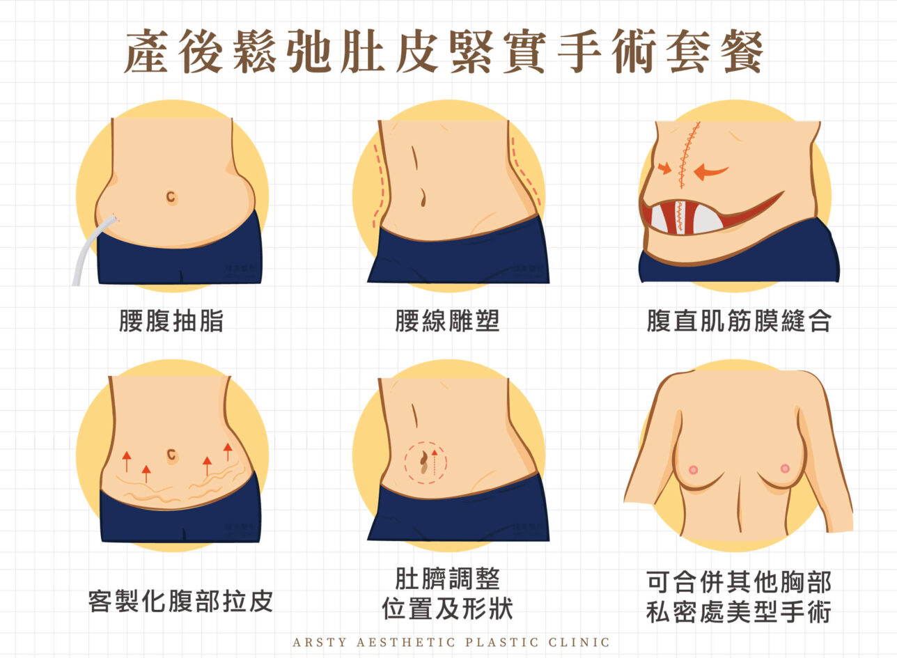 肚臍定位 腹直肌 腹部拉皮手術 產後拉皮 3