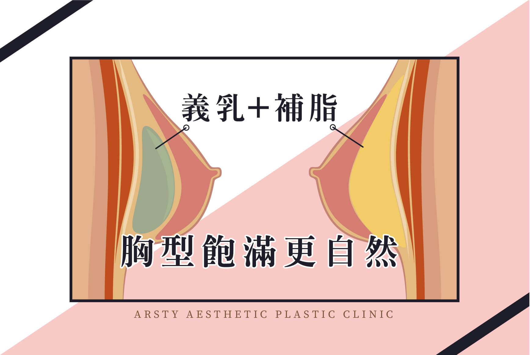 複合式隆乳-首圖-1