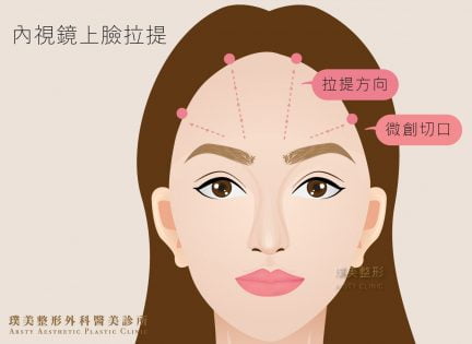 內視鏡上臉拉提/超微創內視鏡提眉-細紋拉提有感,眉眼緊緻小秘密 15 內視鏡提眉 內視鏡上臉拉提 手術 17