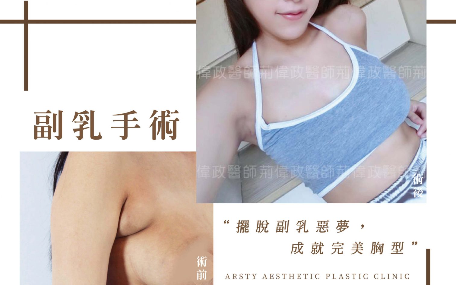 副乳手術台北推薦