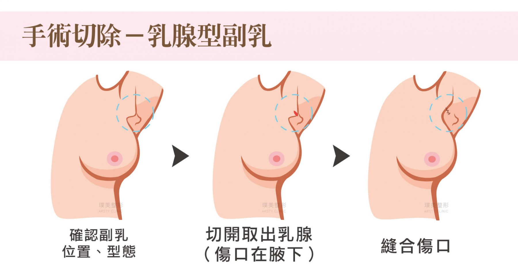 副乳手術方式,手術切除,乳腺型副乳