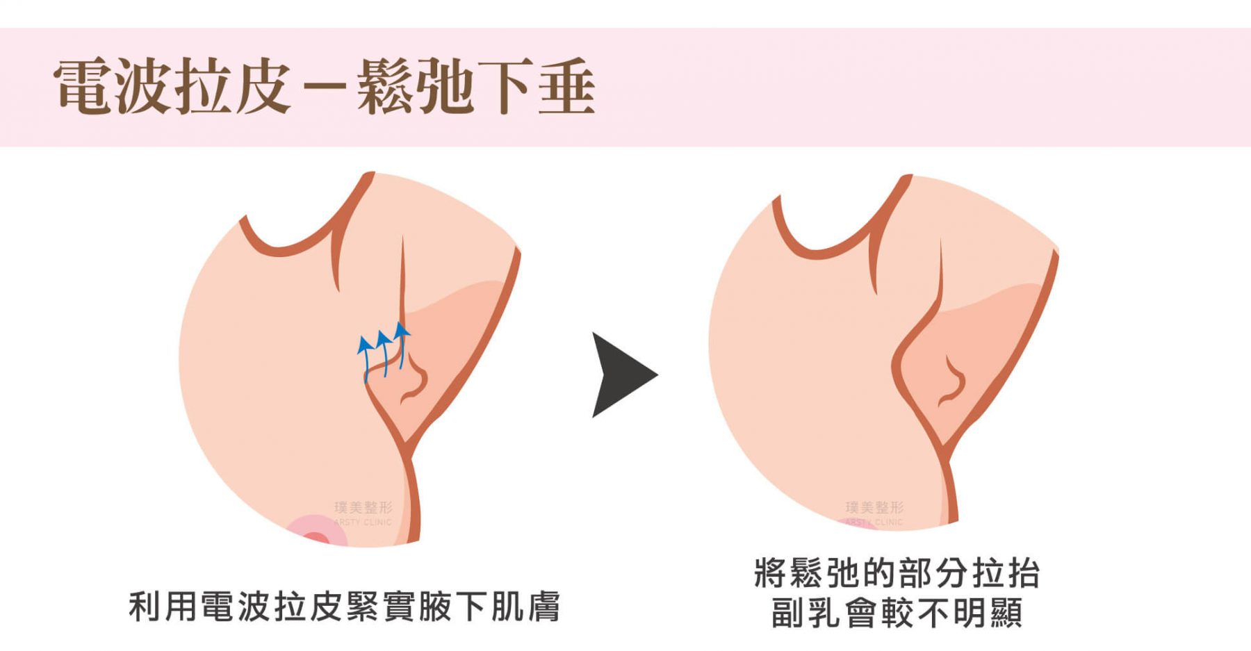 副乳手術方式_電波拉皮,鬆弛下垂