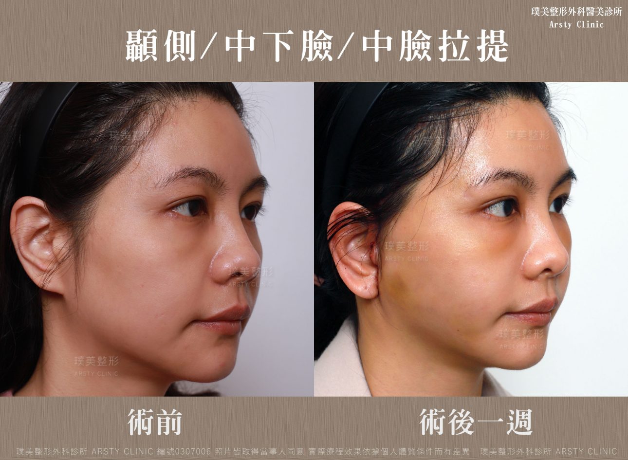 複合式凍齡拉皮 讓我的臉比6年前更小 更緊緻 璞美整形外科