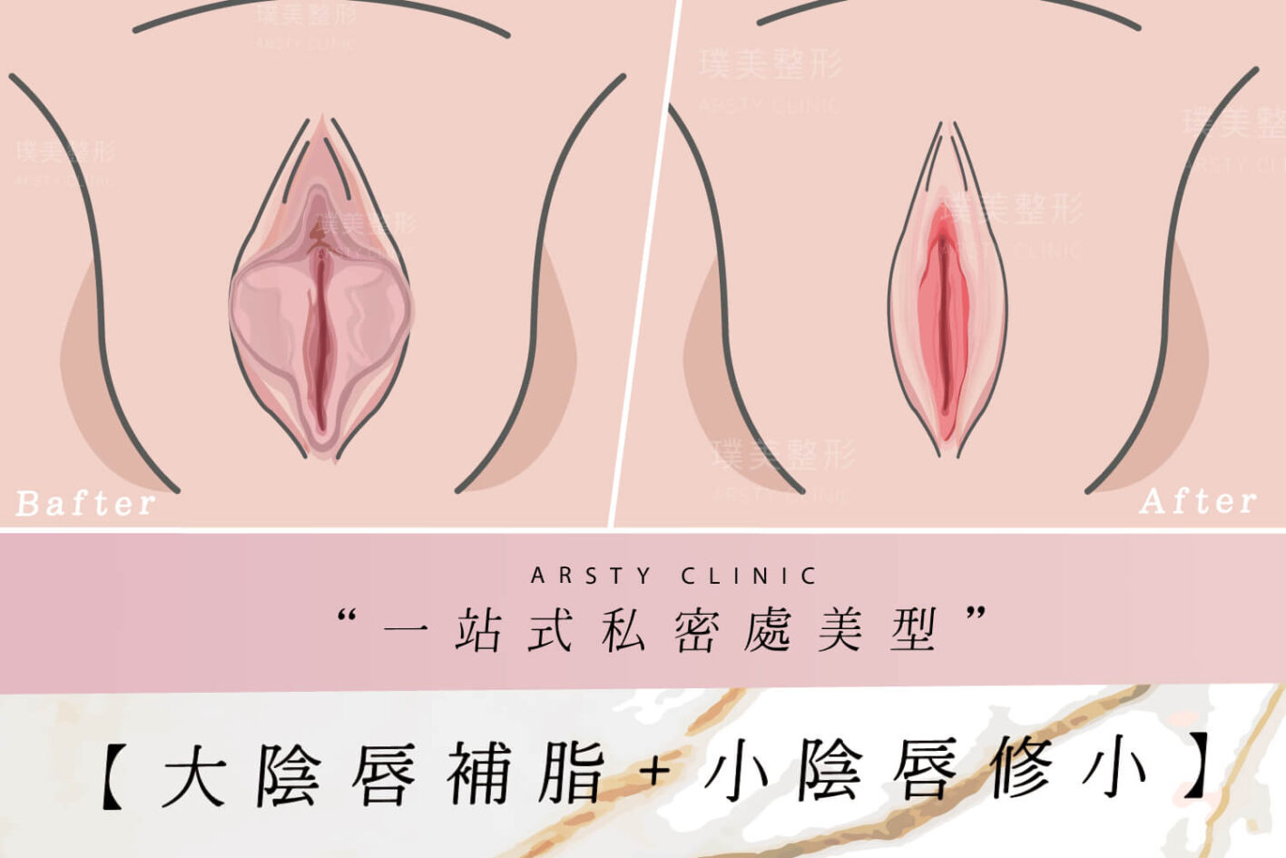 大陰唇補脂小陰唇修小 一站式私密處整形 璞美整形外科