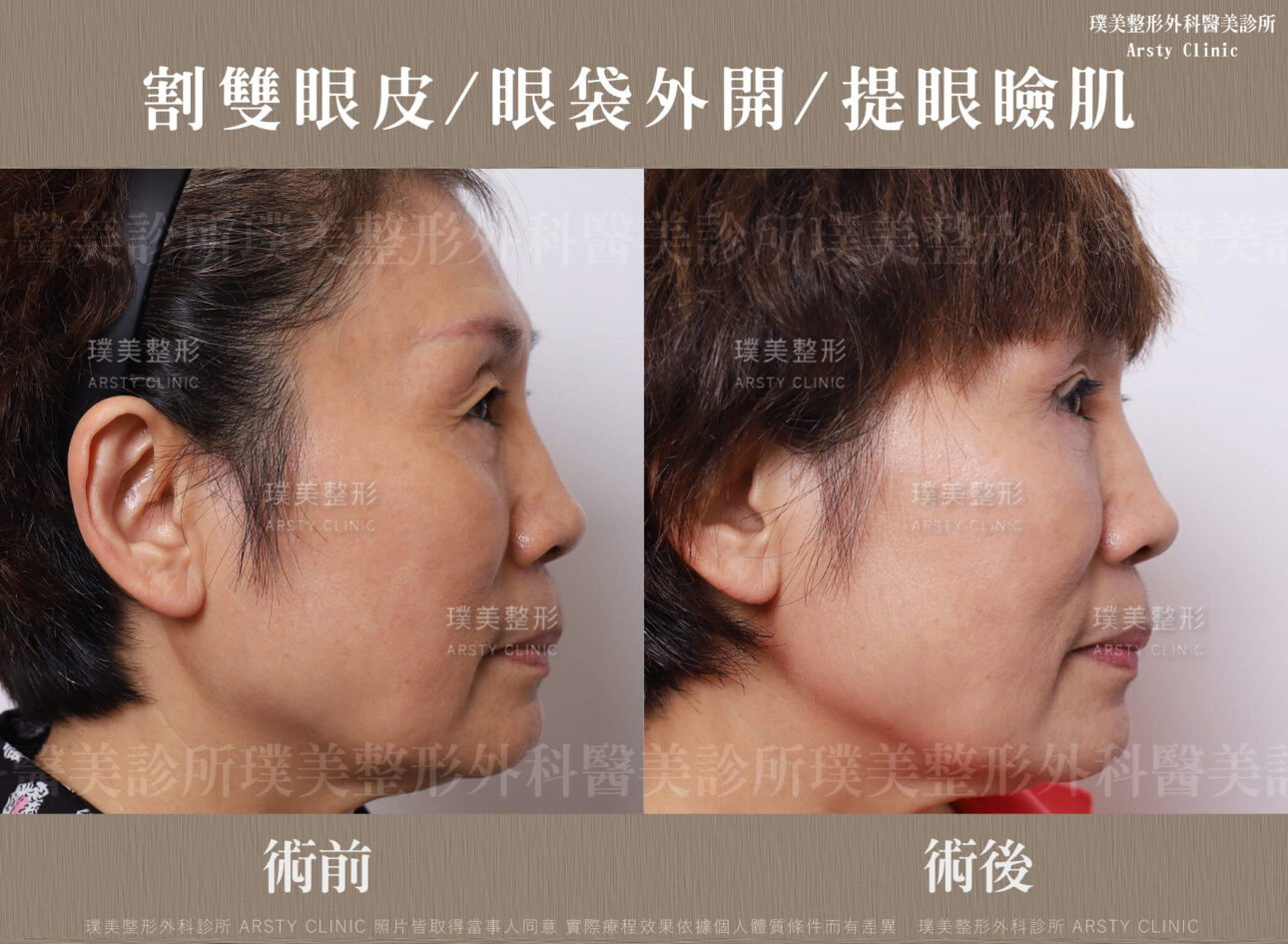 割雙眼皮-眼袋外開-提眼瞼肌-20079-1-右90BA 割雙眼皮 眼袋外開 提眼瞼肌 20079 1 右90BA