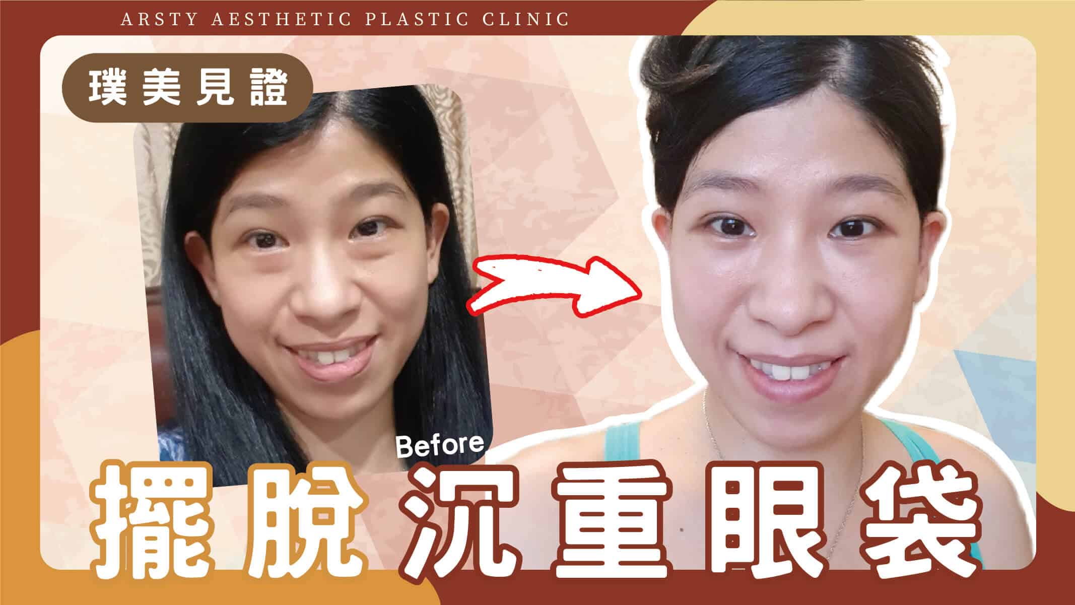 Youtube影片封面-112326_01擺脫沉重眼袋