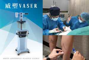 Liposuction Failure - Second Liposuction - Photo Gallery - 01
