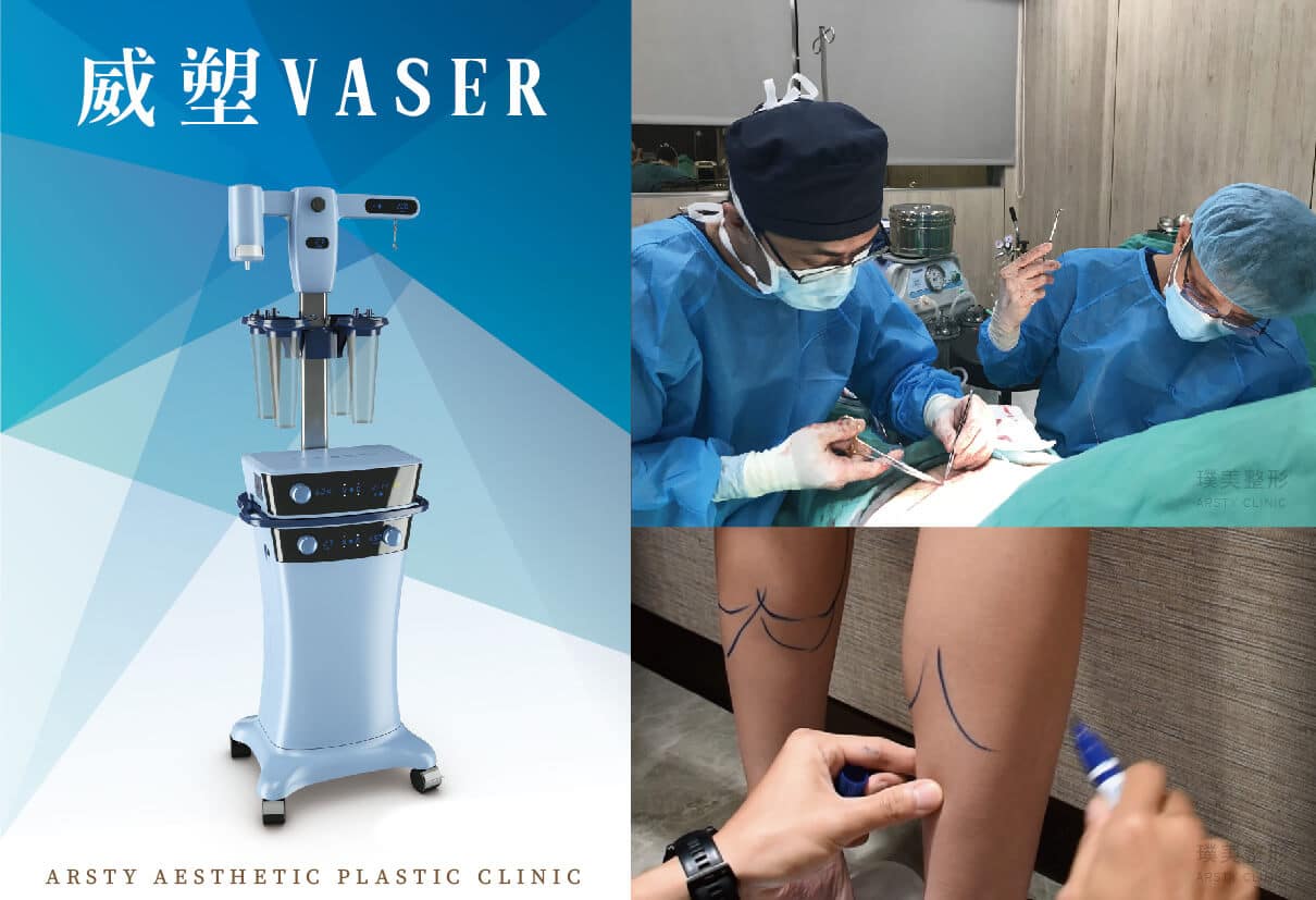 Liposuction Failure - Second Liposuction - Photo Gallery - 01