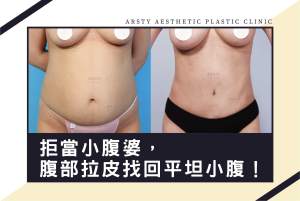 Refuse to be a belly-prone woman, get a Abdominoplasty and regain a flat stomach.