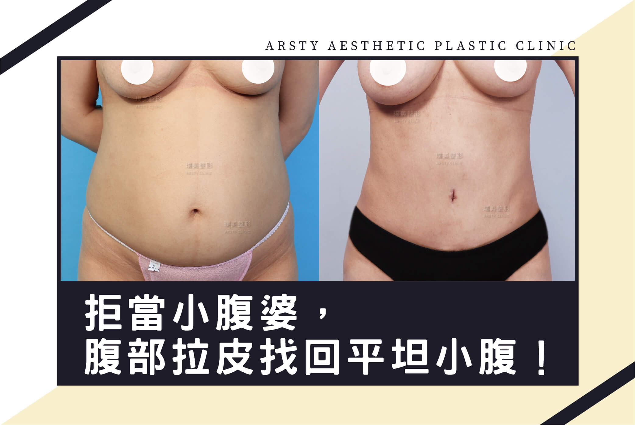 Refuse to be a belly-prone woman, get a Abdominoplasty and regain a flat stomach.