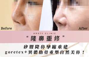 鼻形成術修正手術症例カバー - D0503