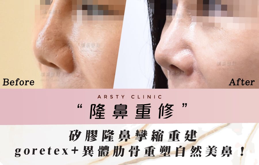 鼻形成術修正手術症例カバー - D0503