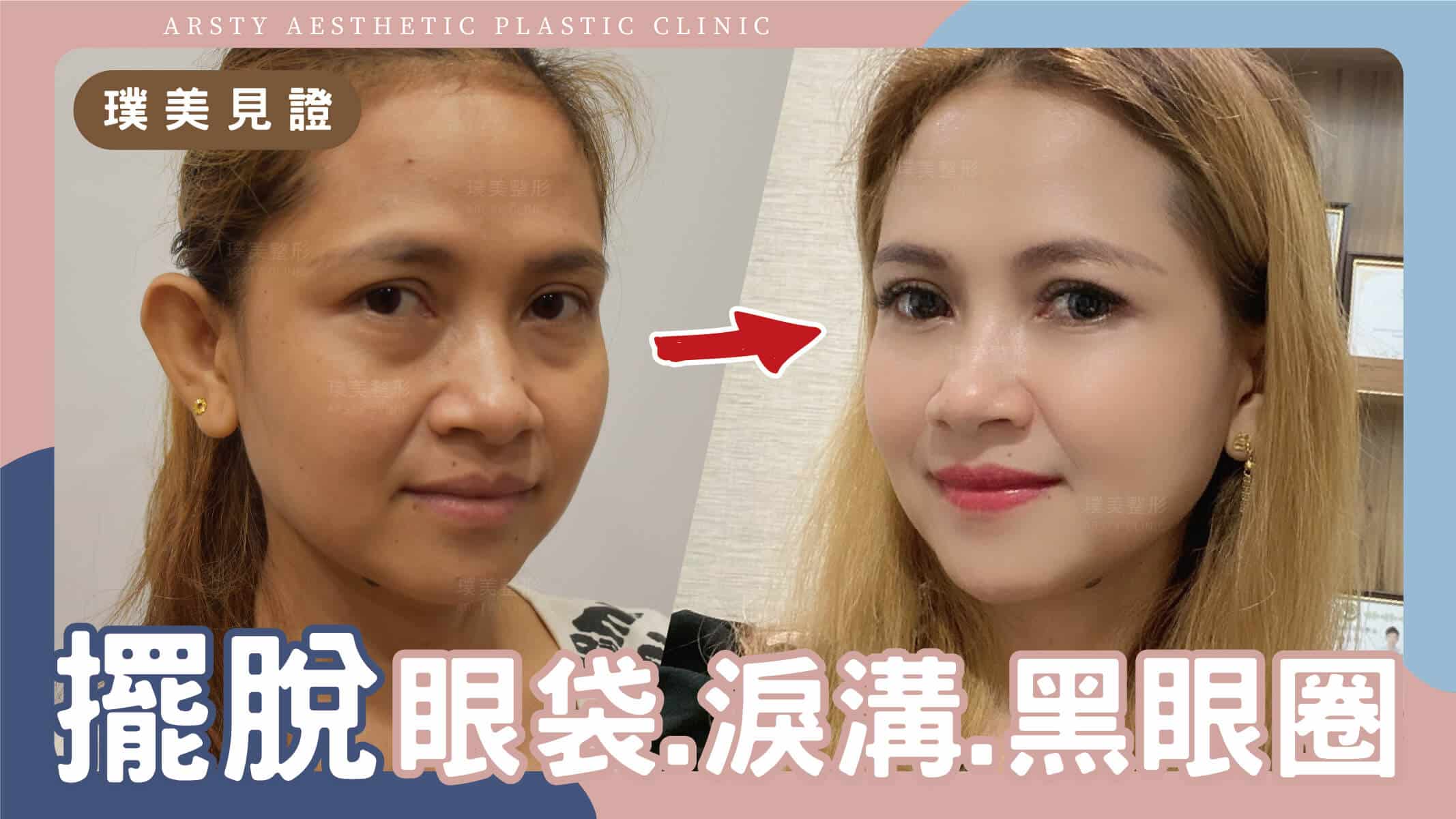 Youtube影片封面-D220720_01擺脫眼袋涙溝黑眼圈