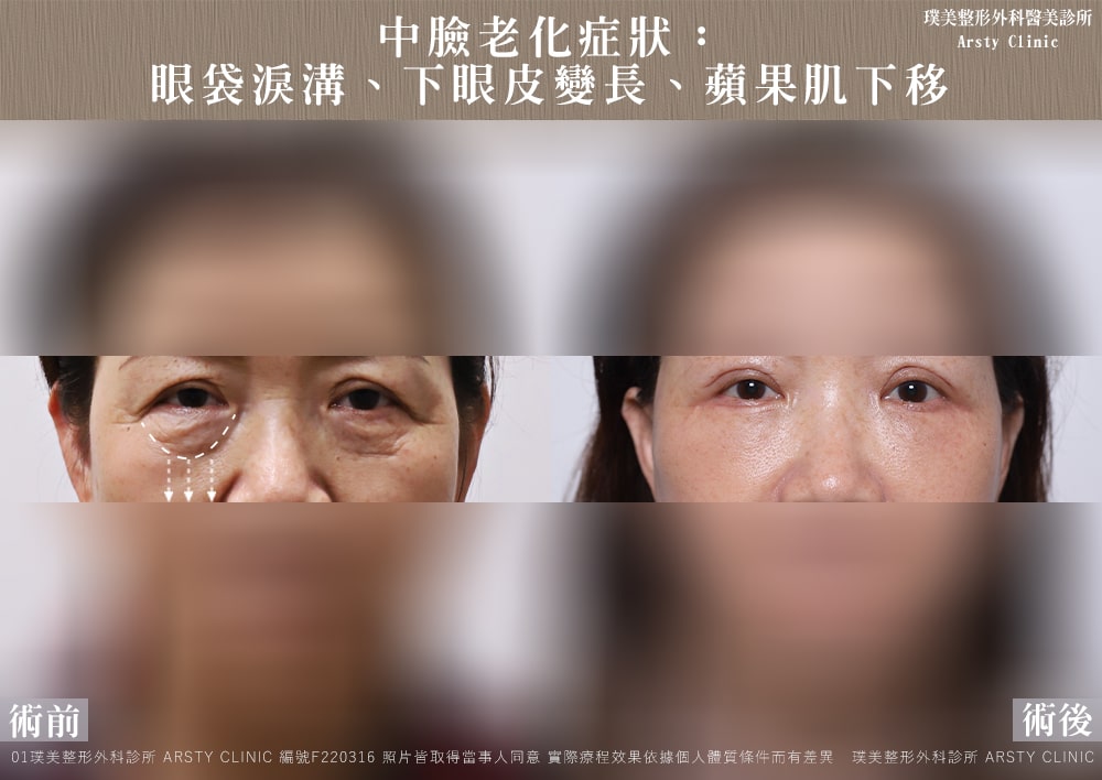 顔の中央部の老化症状：目の下のたるみ、涙溝、下まぶたのたるみ、頬骨のたるみ。（F220316_1_目の下のたるみ - 曇り）