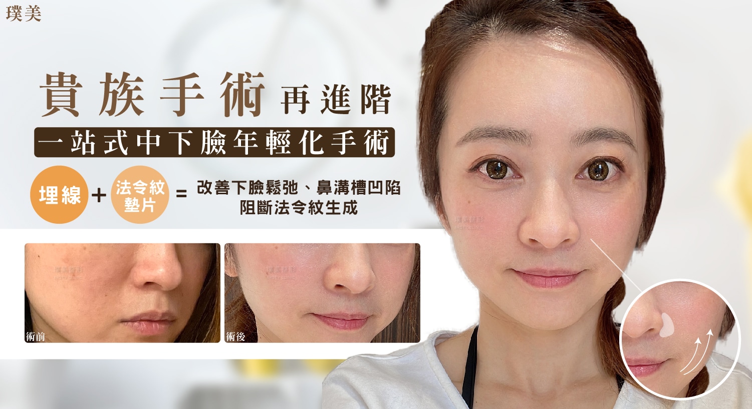 D221025-Goretex Blue Diamond Fishbone Thread Lift Improves Sagging and Nasal Groove Depression - 1