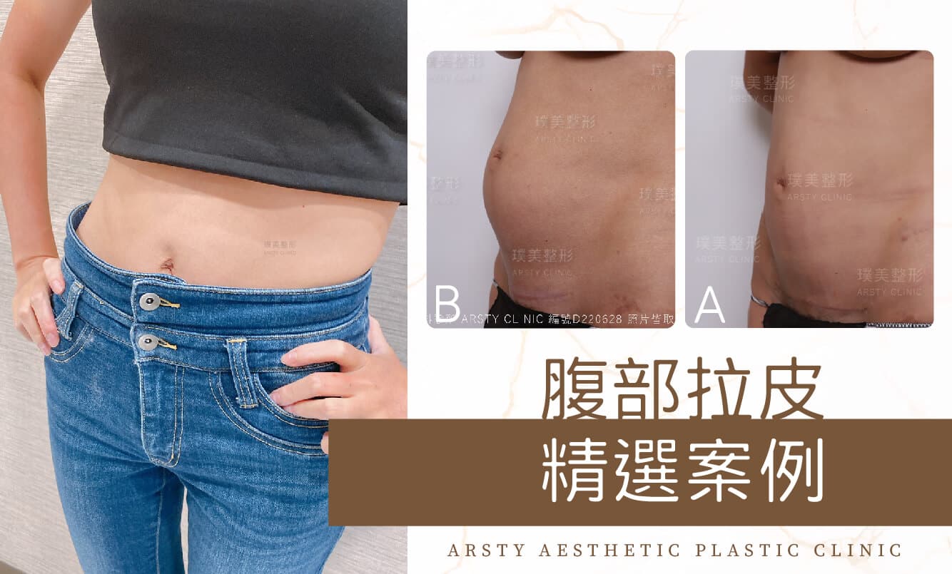 Featured Case Cover - 11 Arsty Clinic Abdominoplasty