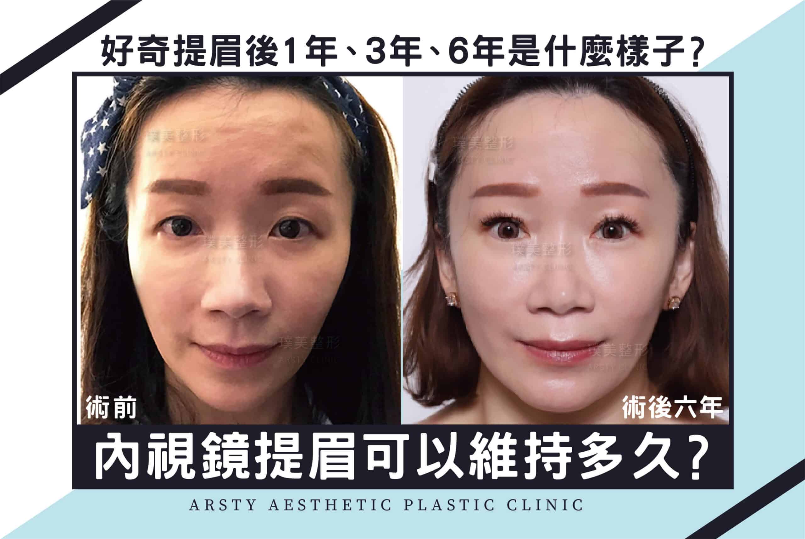 2022 Medical News Cover_03 The Time Efficacy of Endoscopic Forehead Lift - 1 - Scaled - 1