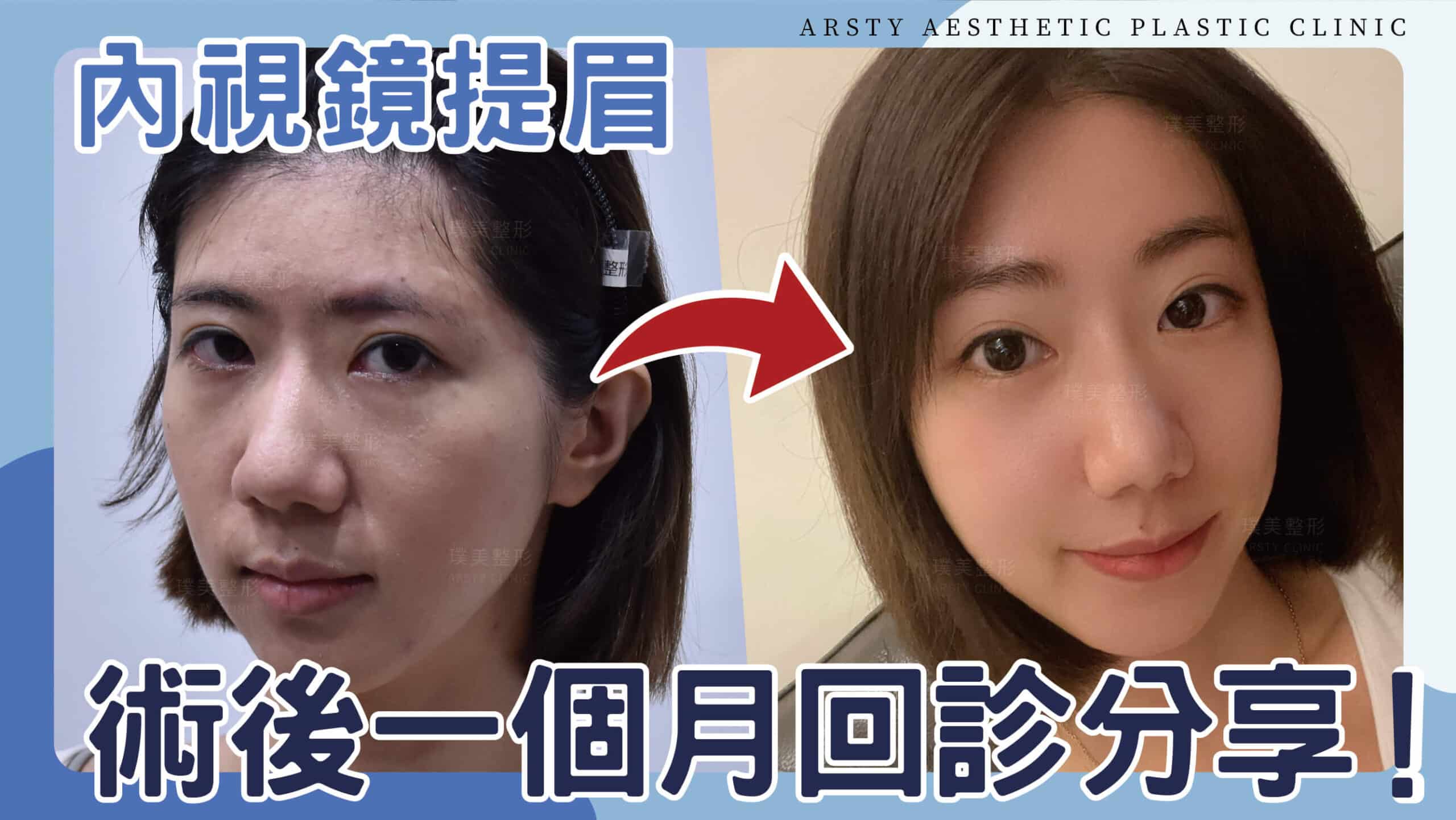YouTube video cover - E220704_01j Endoscopic Forehead Lift, looks amazing one month post-surgery - scaled-1