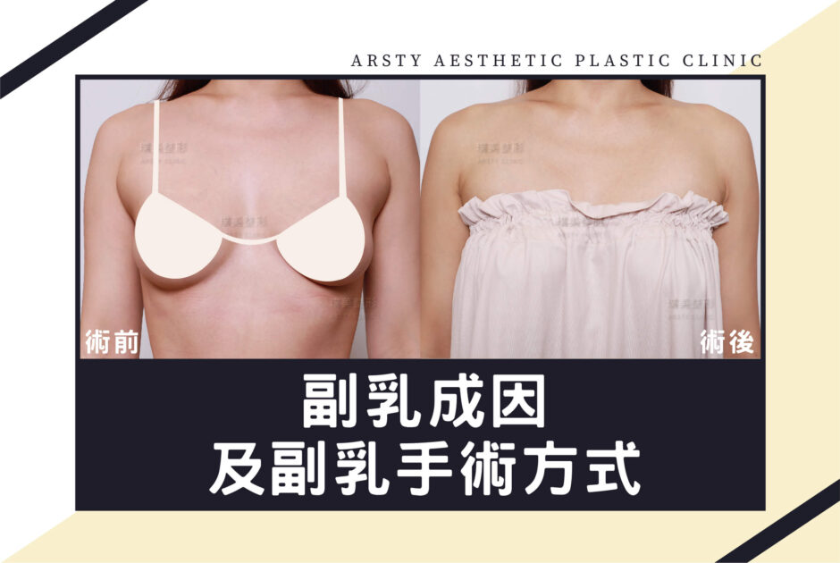 璞美醫學新知_副乳成因及副乳手術方式