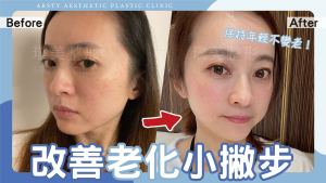 Arsty Clinic — Cover of the video for improving nasolabial folds - D221025_01