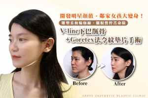 Dr. Wei-Cheng Ching's jaw reduction surgery recommendations: jaw reduction, V-line chin, Gorete nasolabial fold augmentation. (Cover image - 07)