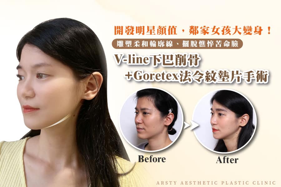 Dr. Wei-Cheng Ching's jaw reduction surgery recommendations: jaw reduction, V-line chin, Gorete nasolabial fold augmentation. (Cover image - 07)