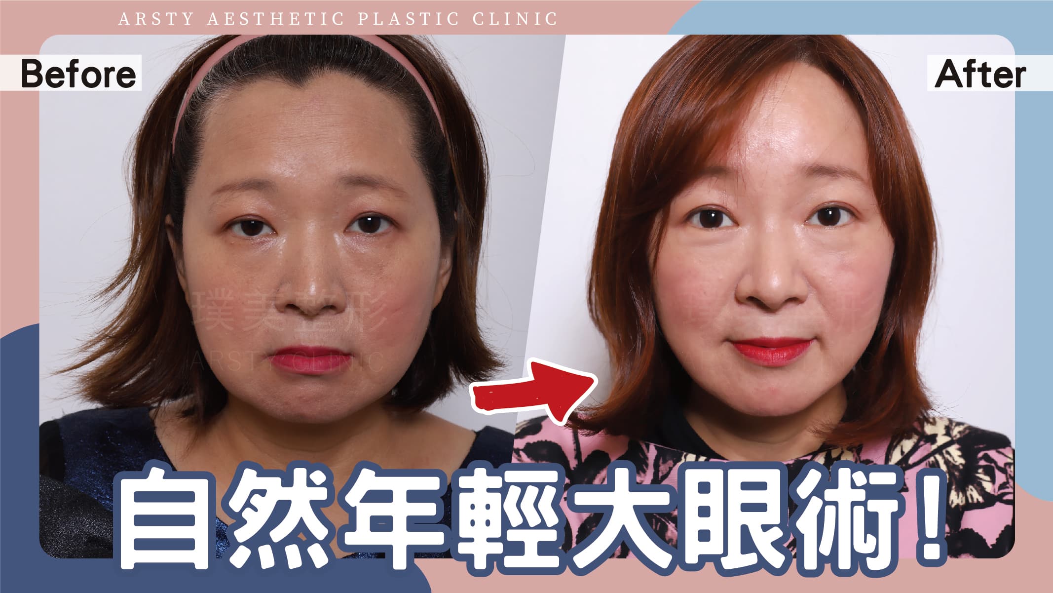 Cover of Arsty Clinic Eyebrow Lift Case Video - D221227_01