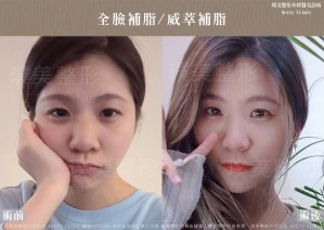 Arsty Clinic陳心瑜醫師_臉部補脂_淚溝威萃案例-E221226_生活照01